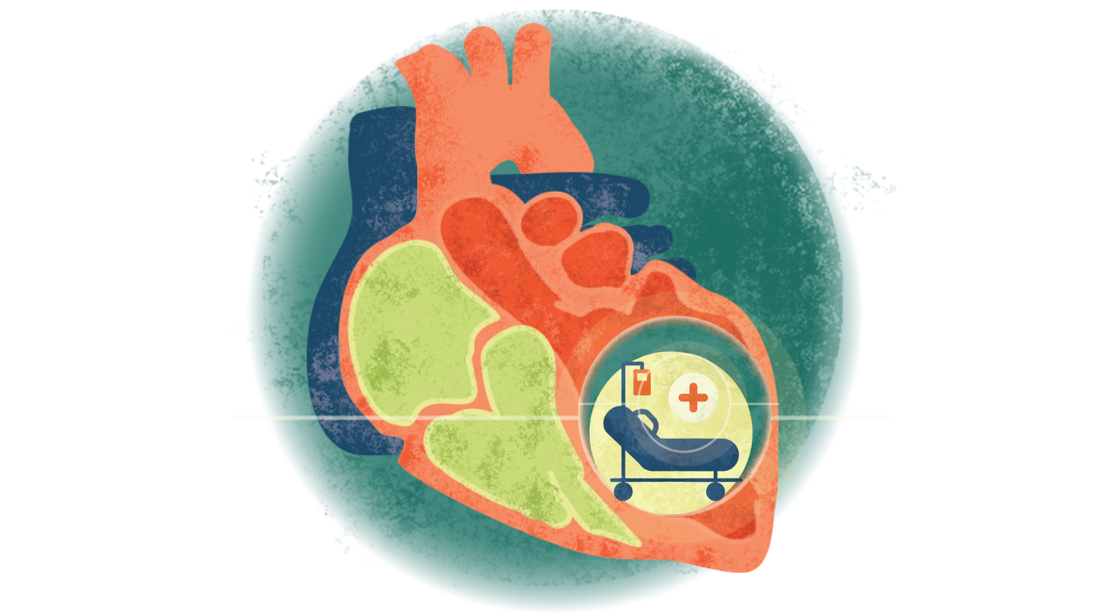 Illustration of a hospital bed, IV, and a red medical plus icon in a circle over a heart with cardiomyopathy