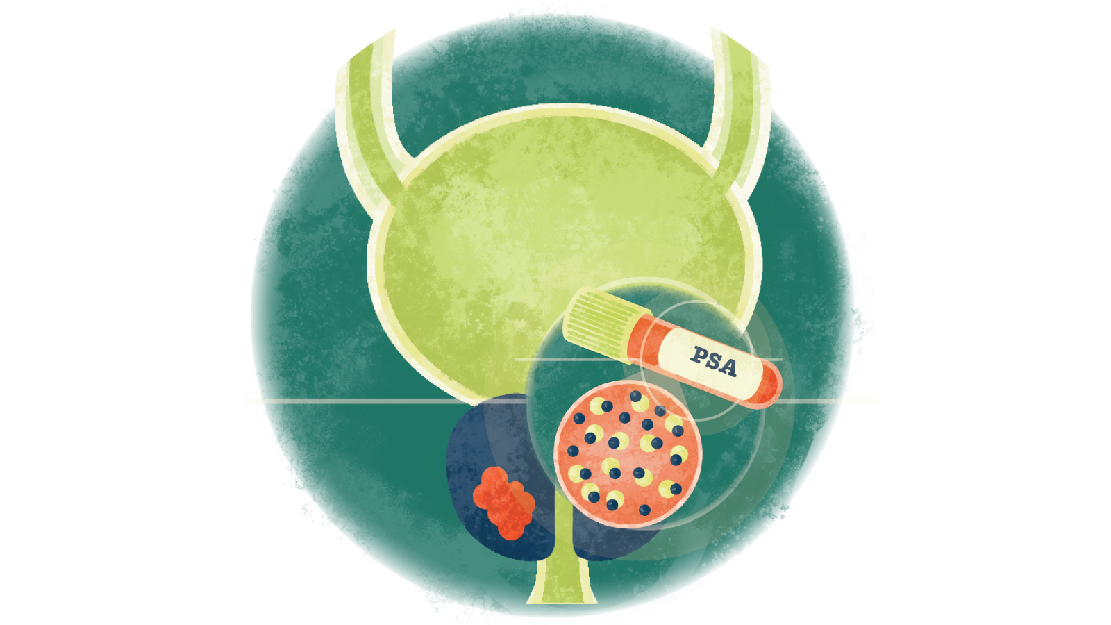 Illustration of a PSA test over a prostate with cancer