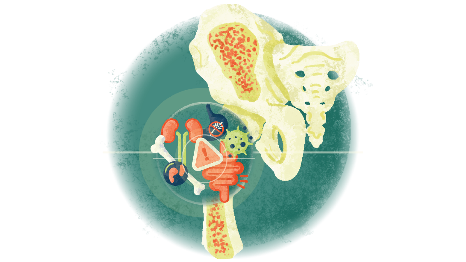 Illustration of different images of medical conditions that can cause osteoporosis over a bone with osteoporosis